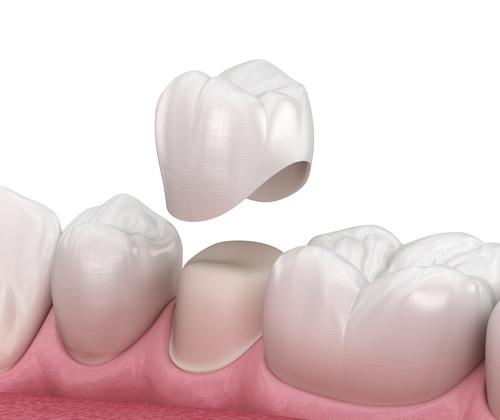 Example of a dental crown
