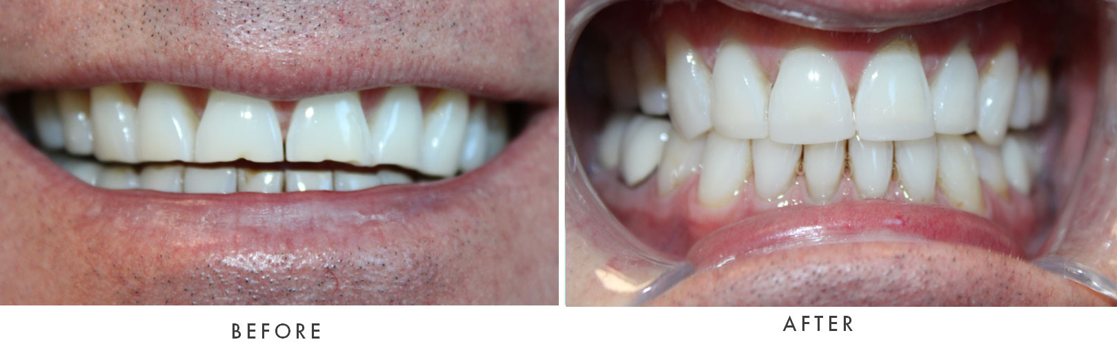 close up of before and after dental procedure results