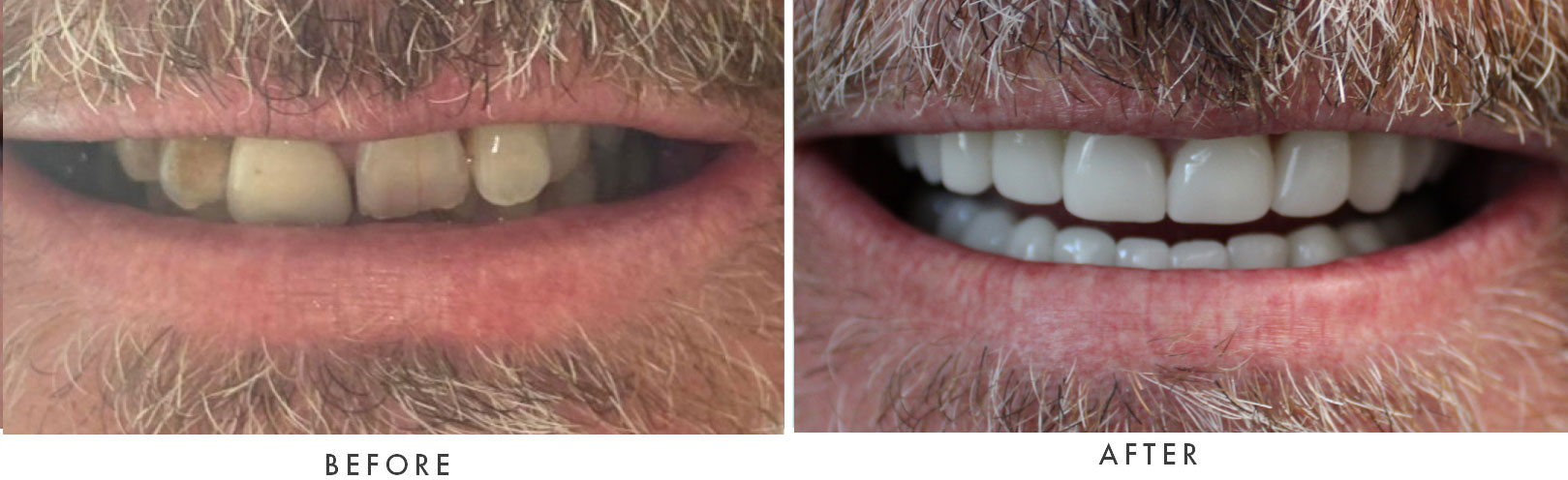 close up of before and after dental procedure results