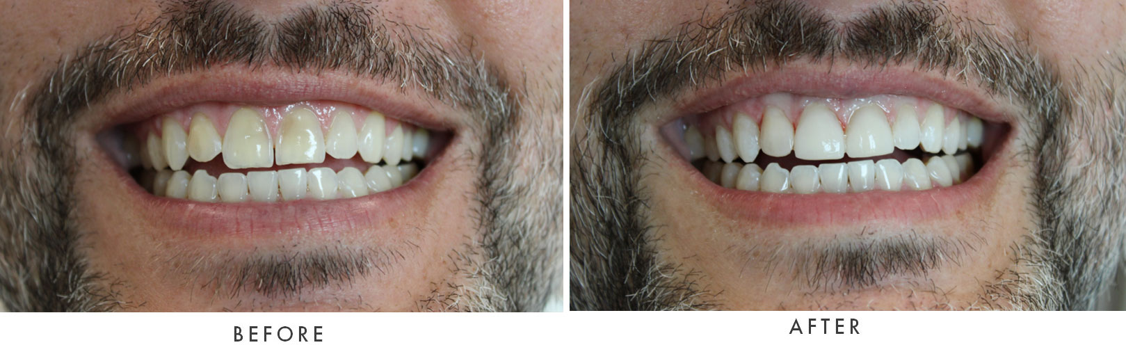 close up of before and after dental procedure results