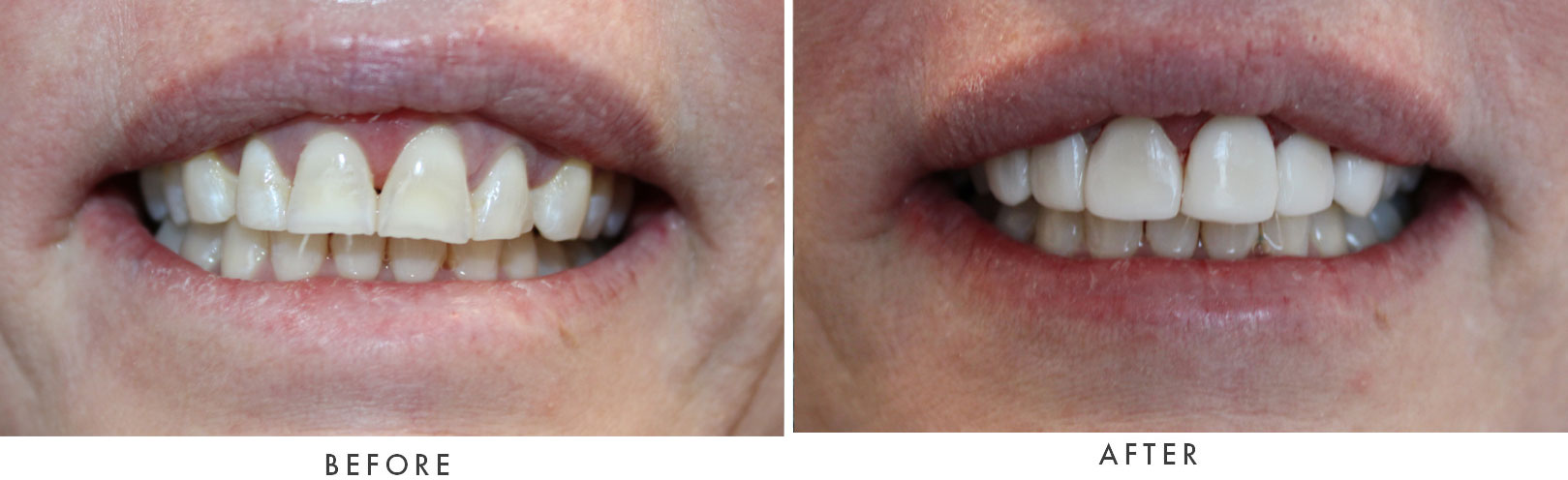 close up of before and after dental procedure results