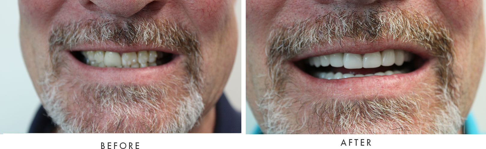 Before and after photo of dental procedure