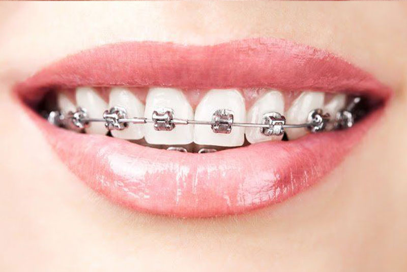 Close up of damon braces