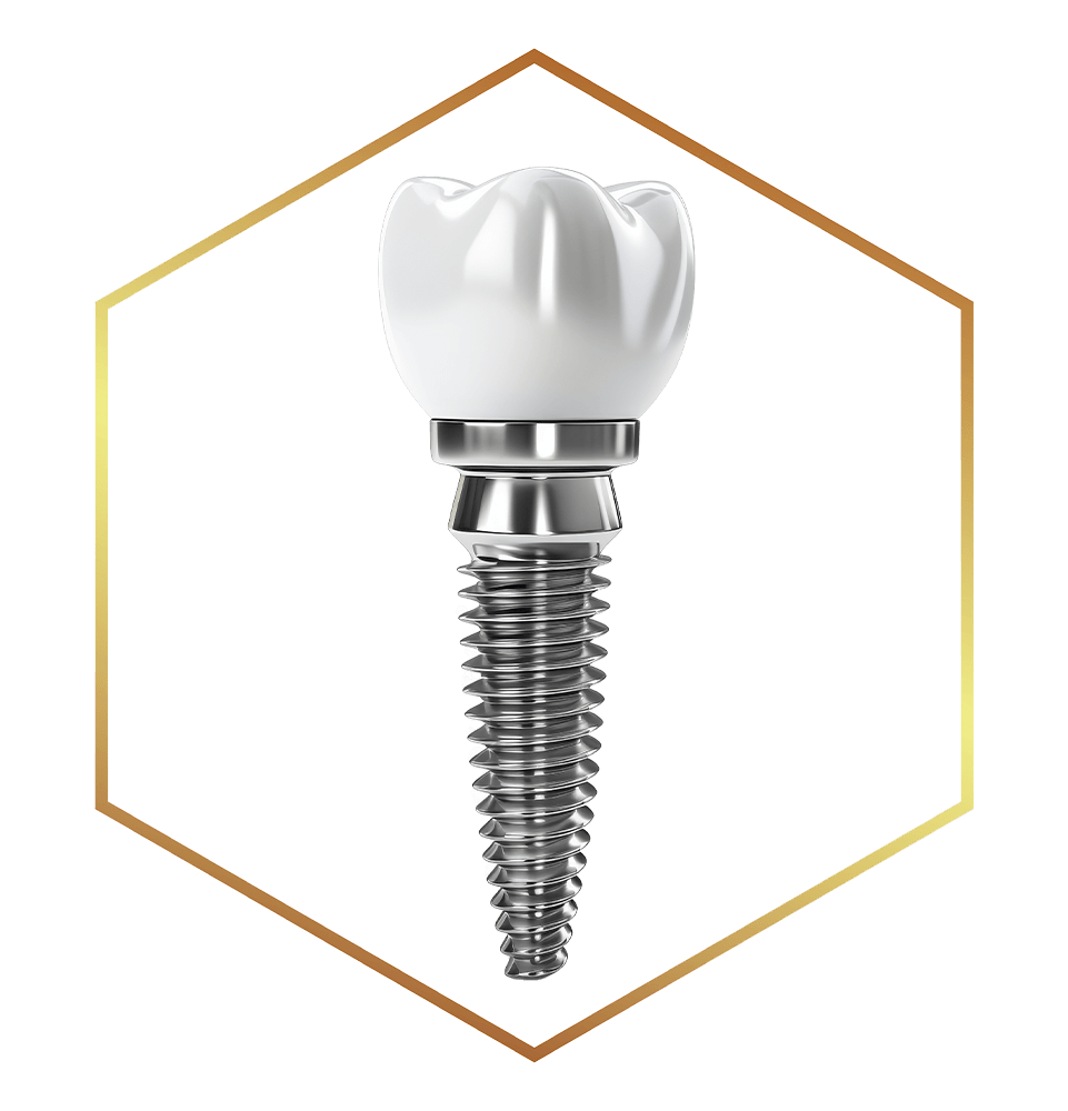 dental implant frame