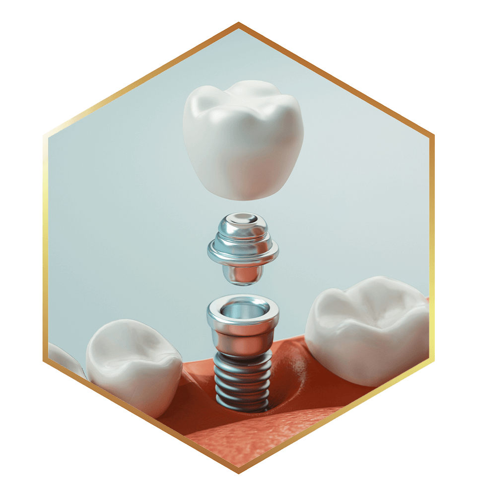 close up of single dental implant