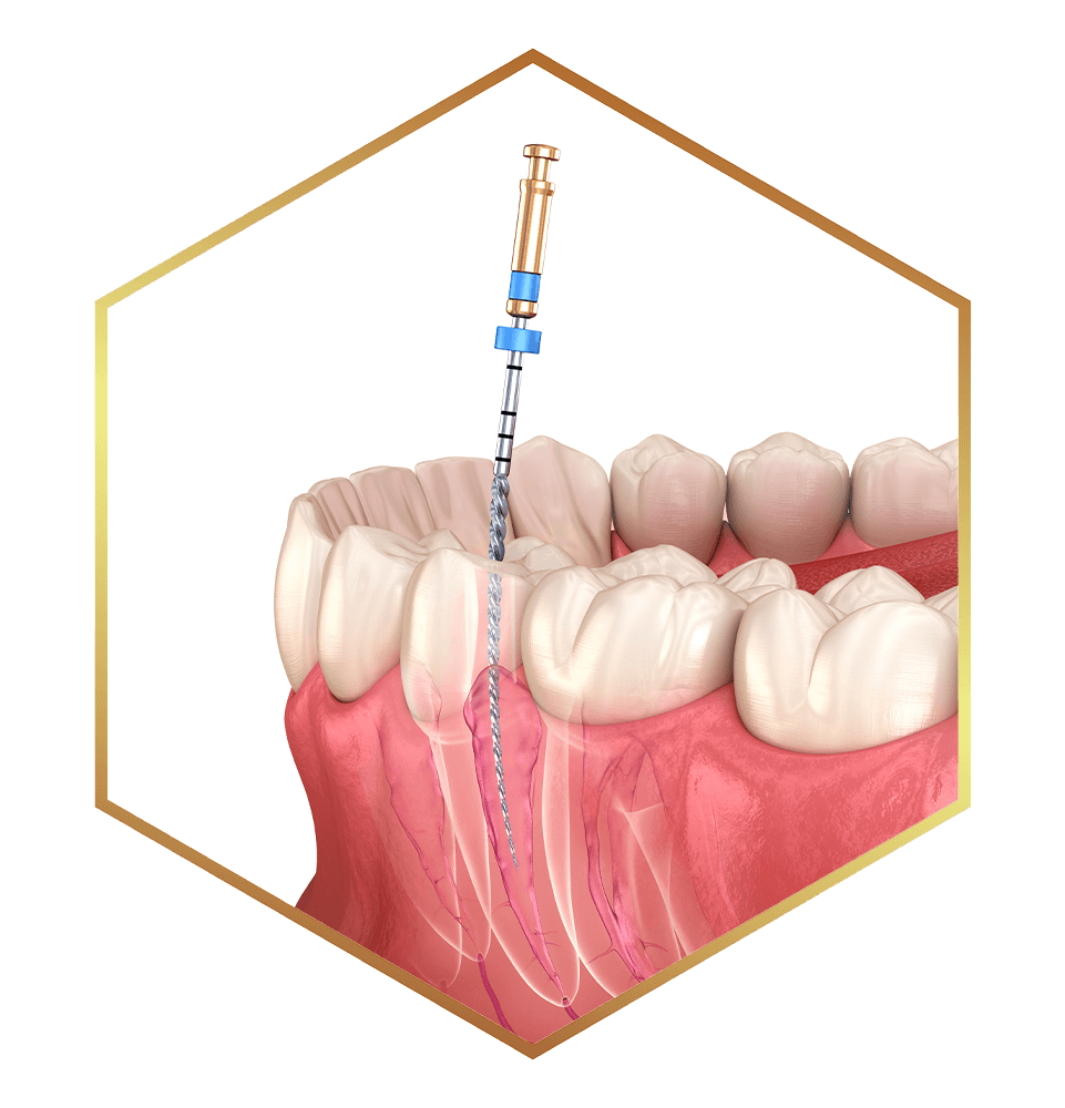 frame of root canal illustration