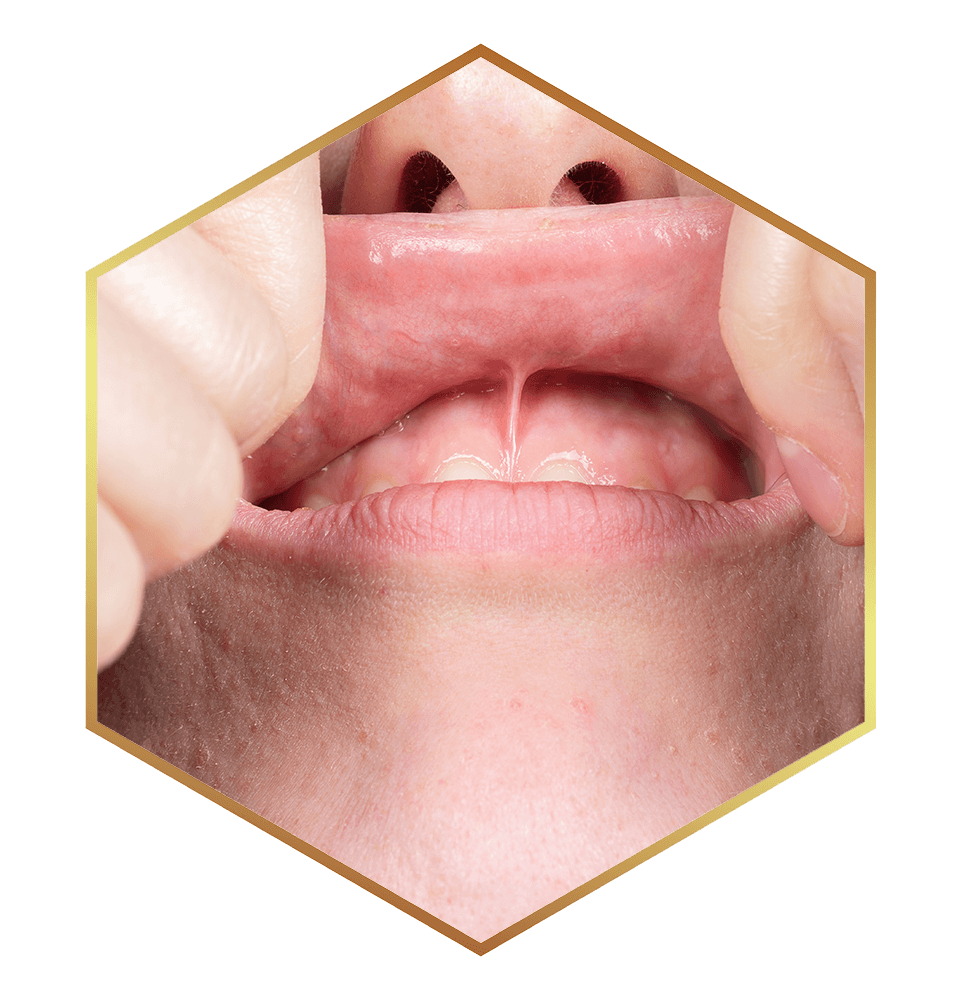 frame of frenectomy lip tie illustration