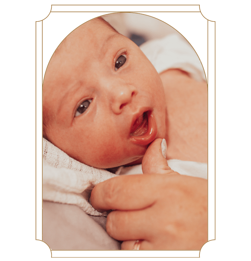 baby undergoing frenectomy examination