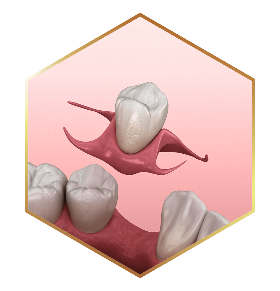 close up illustration of immediate denture