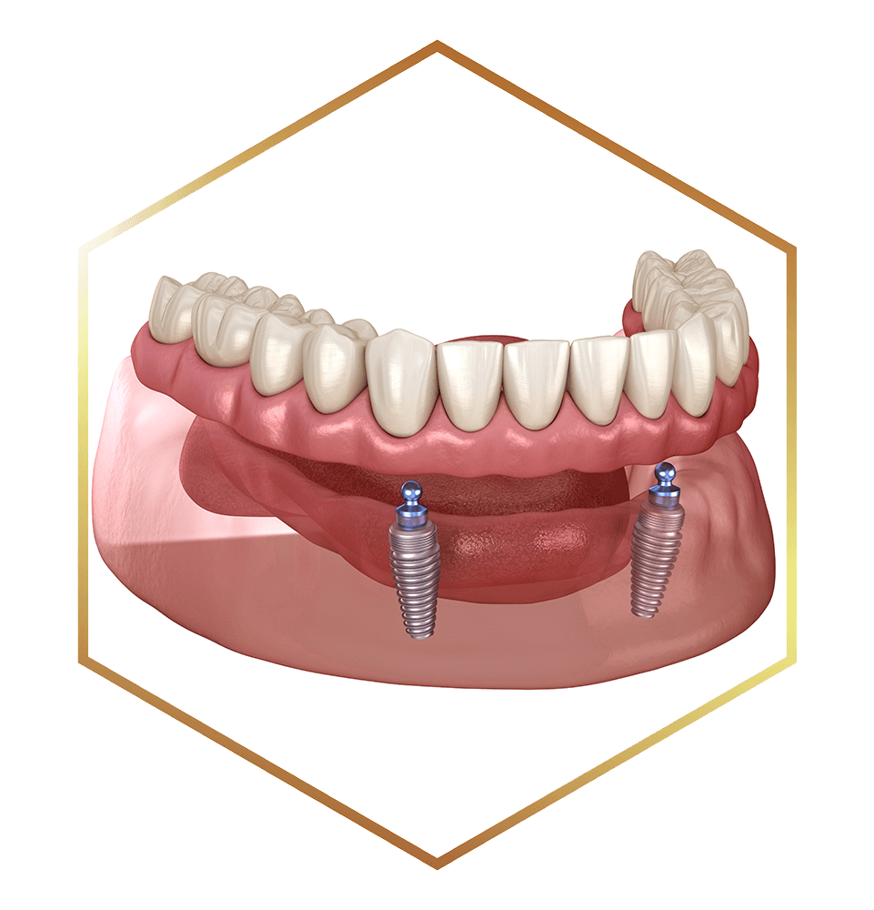 close up of implant supported dentures