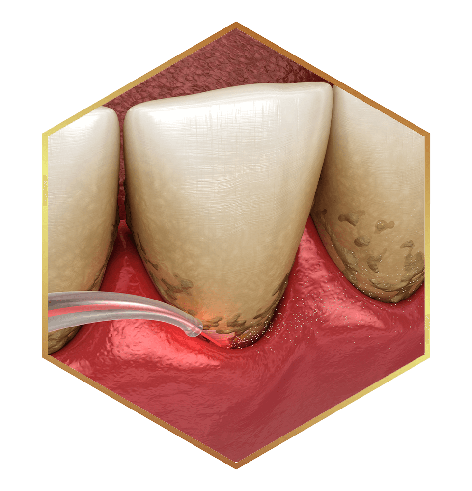 frame of laser periodontics