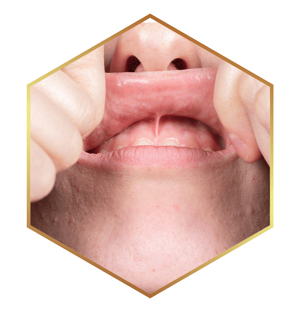 close up of person with lip-tie