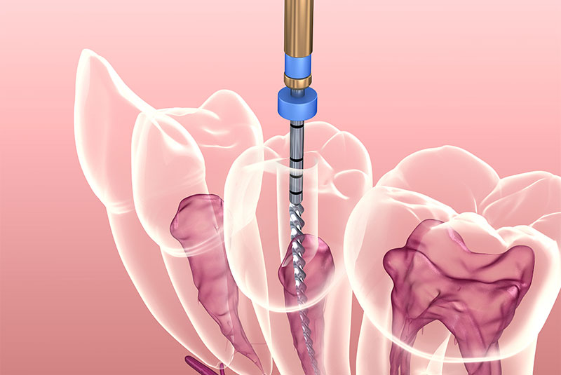 endodontic treatment illustration