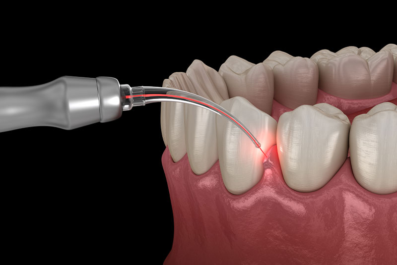 laser frenectomy procedure illustration
