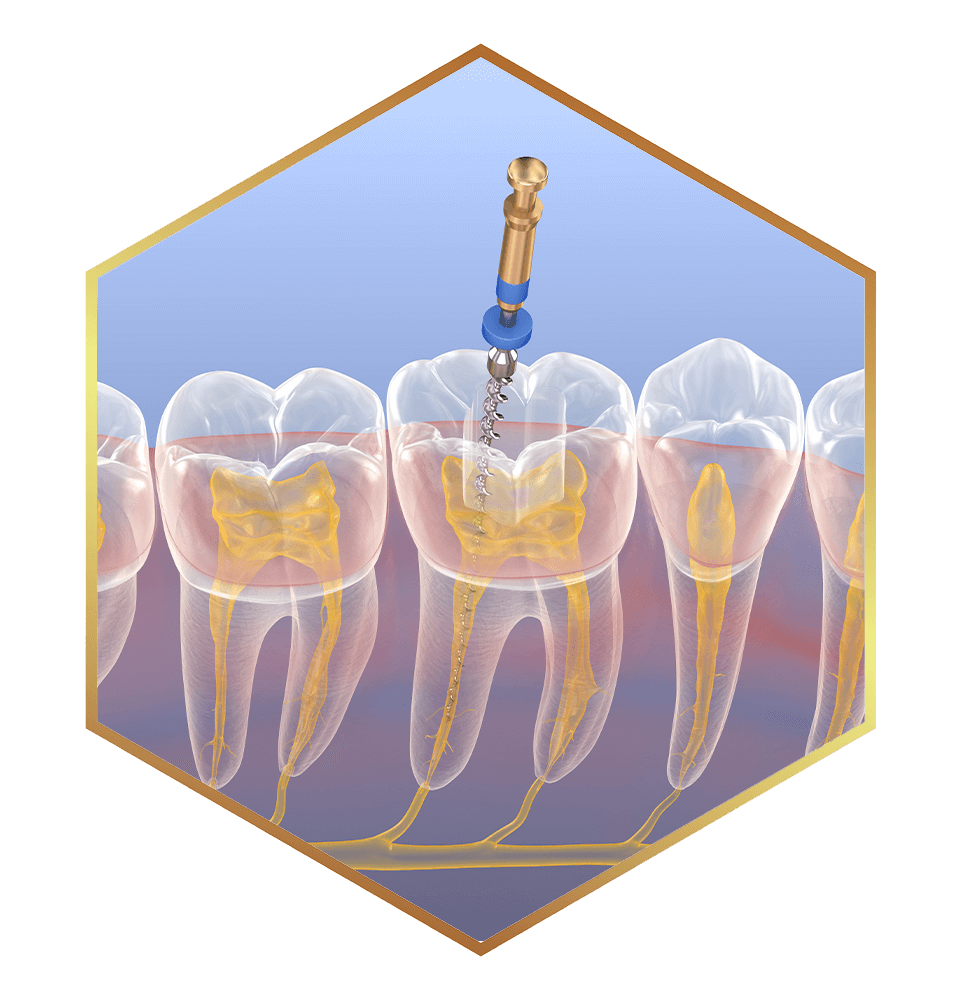 frame of root canal illustration