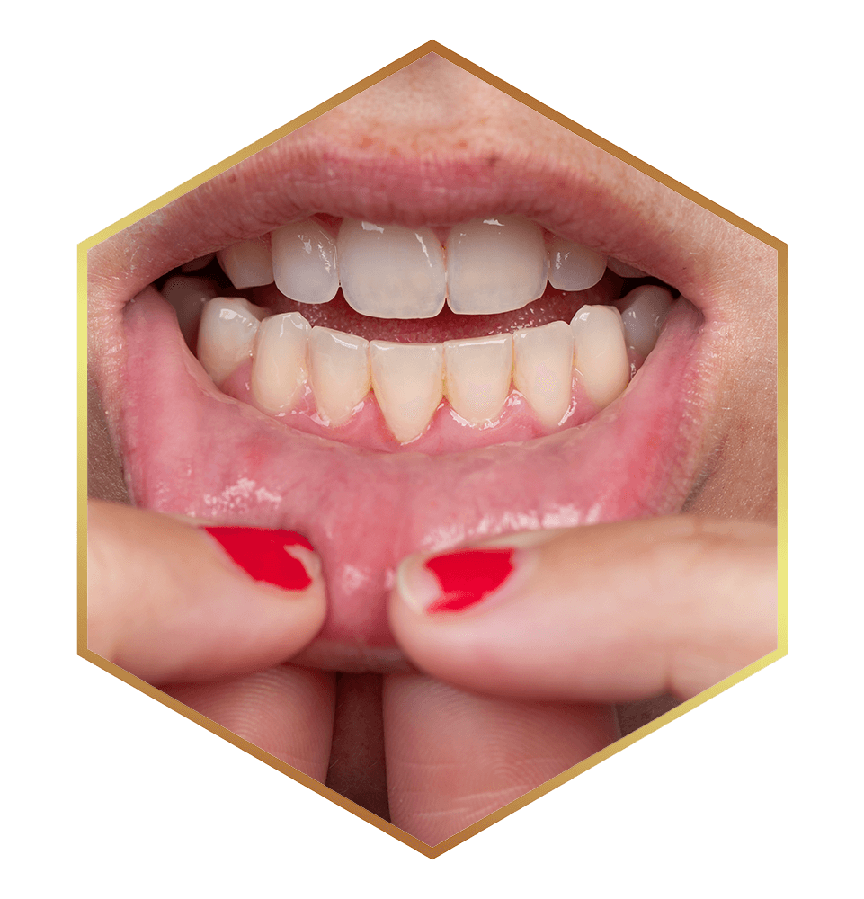 person with tongue tie