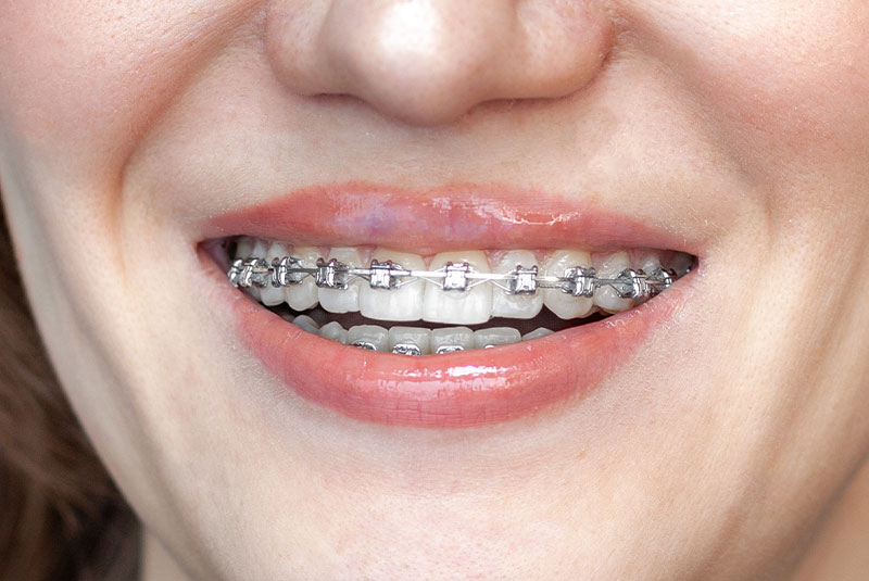 close up of traditional braces