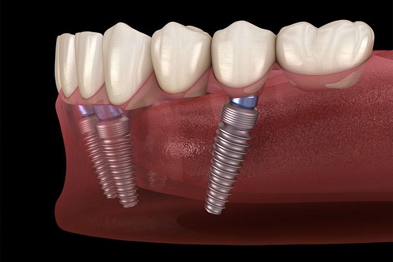 close up of full dental implant illustration