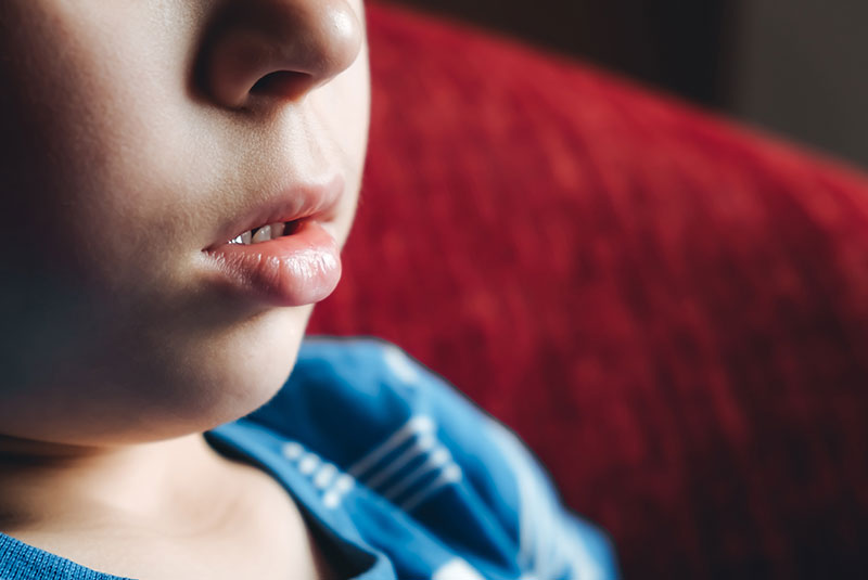 open mouth breathing due to frenectomy